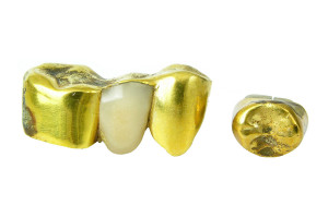 Wir kaufen Zahngold aller Art in NRW an, Solingen, Düsseldorf, Wuppertal, vergoldete Zähne, Zahnschmuck, Rares Gold gegen Bares